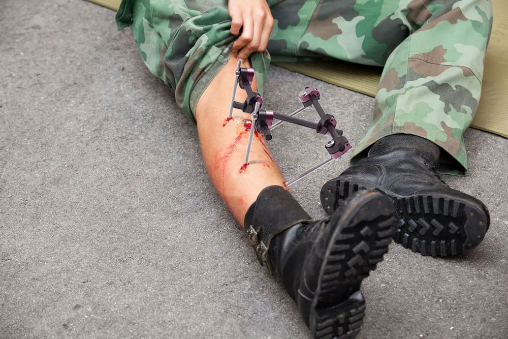 External Fixator on Leg Fracture - Pompac System