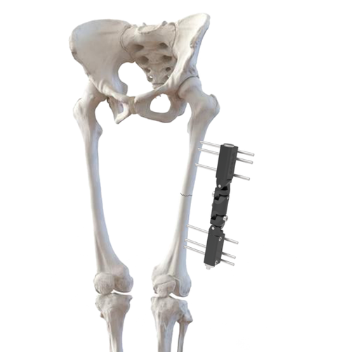 External Warac Fixator