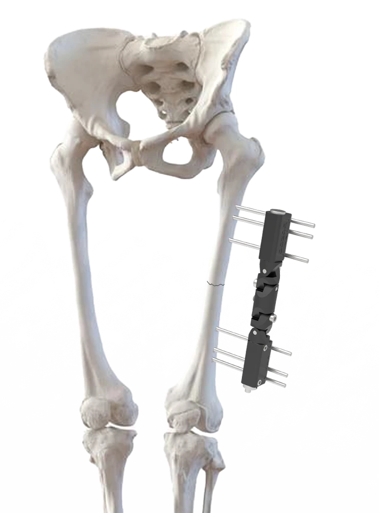 Warac Unilateral Fixator System